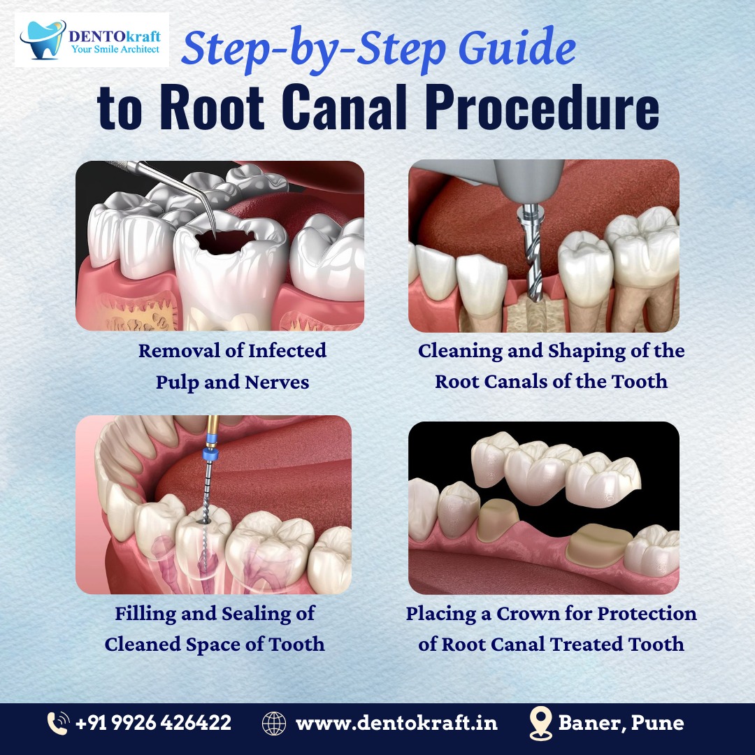 Step-by-Step Guide to Root Canal Procedure