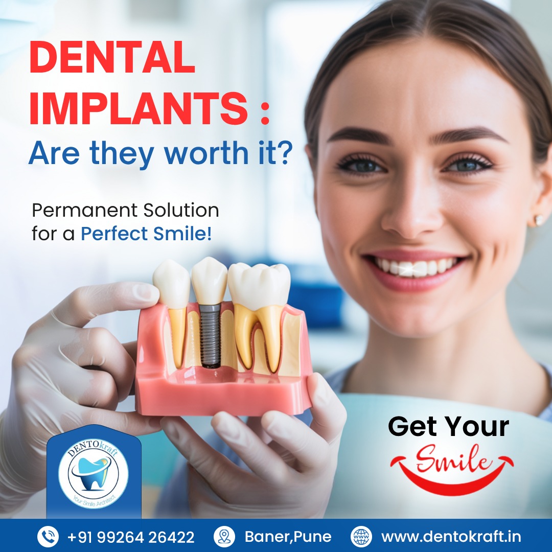Dental Implants - Are They Worth It?