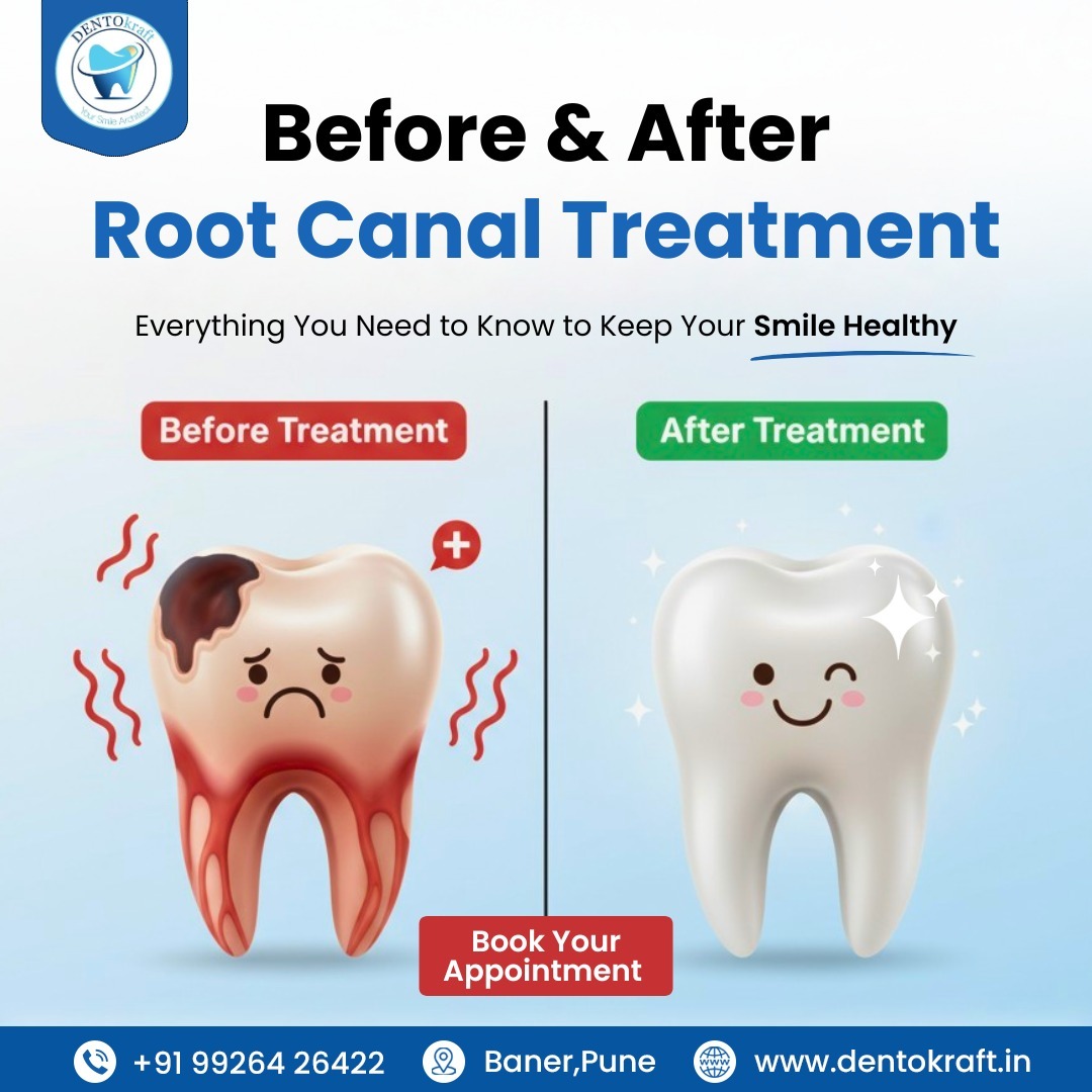Everything you need to known before and after root canal treatment
